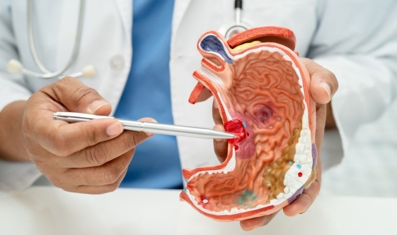 Cáncer de estómago, factores de riesgo y prevención